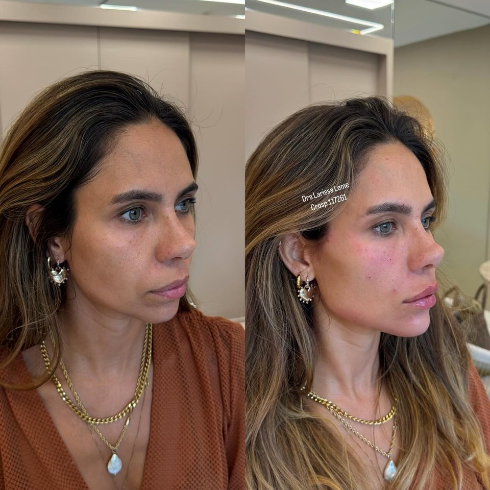 Caso 02: antes e depois de tratamento da Dra. Lari Leme