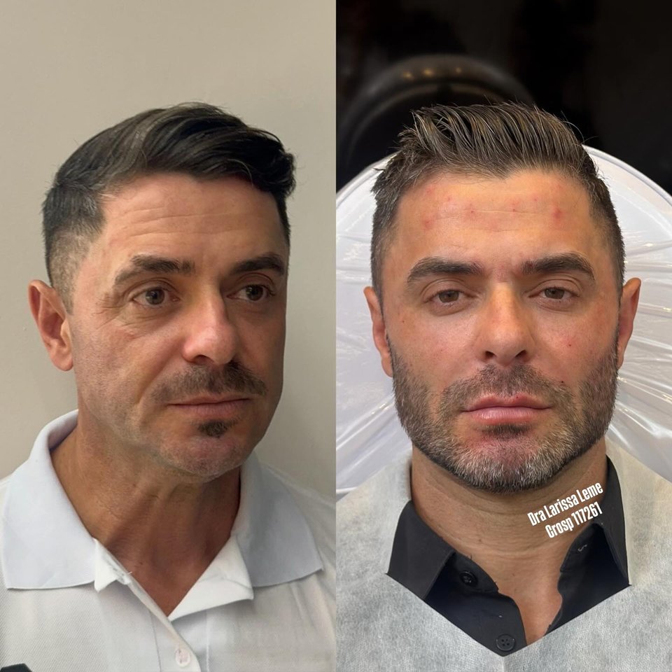Caso 03: antes e depois de tratamento da Dra. Lari Leme